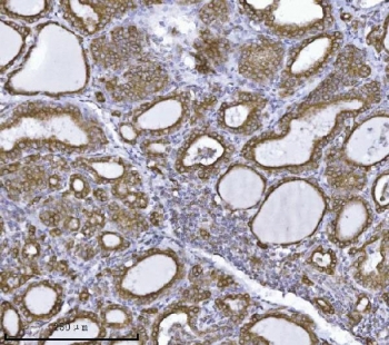 IHC staining of FFPE human thyroiditis tissue with ERLIN2 antibody. HIER: boil tissue sections in pH8 EDTA for 20 min and allow to cool before testing.