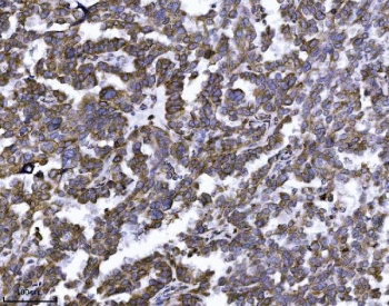 IHC staining of FFPE human ovarian serous carcinoma tissue with ERLIN2 antibody. HIER: boil tissue sections in pH8 EDTA for 20 min and allow to cool before testing.
