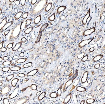 IHC staining of FFPE human renal cancer tissue with Lactadherin antibody. HIER: boil tissue sections in pH8 EDTA for 20 min and allow to cool before testing.