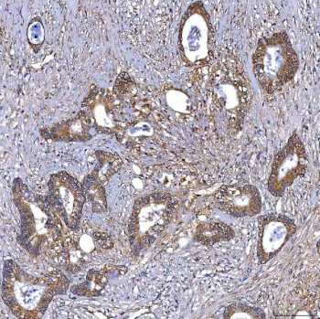 IHC staining of FFPE human colon cancer tissue with TRMT2B antibody. HIER: boil tissue sections in pH8 EDTA for 20 min and allow to cool before testing.