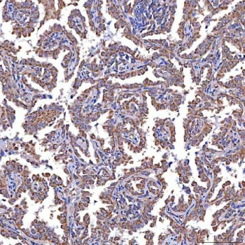 IHC staining of FFPE human lung cancer tissue with TRMT2B antibody. HIER: boil tissue sections in pH8 EDTA for 20 min and allow to cool before testing.