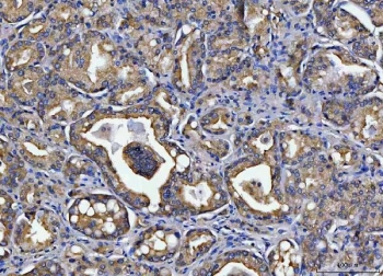 IHC staining of FFPE human prostate cancer tissue with Toll-interacting protein antibody. HIER: boil tissue sections in pH8 EDTA for 20 min and allow to cool before testing.