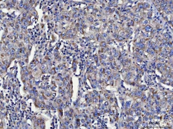 IHC staining of FFPE human cervical cancer tissue with Toll-interacting protein antibody. HIER: boil tissue sections in pH8 EDTA for 20 min and allow to cool before testing.