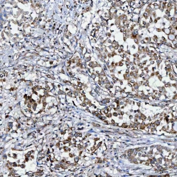 IHC staining of FFPE human lung adenocarcinoma tissue with SELT antibody. HIER: boil tissue sections in pH8 EDTA for 20 min and allow to cool before testing.
