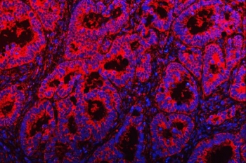 Immunofluorescent staining of FFPE human rectal cancer tissue with TOM1L1 antibody (red) and DAPI nuclear stain (blue). HIER: steam section in pH8 EDTA buffer for 20 min.