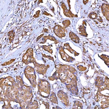 IHC staining of FFPE human breast cancer tissue with TOMM34 antibody. HIER: boil tissue sections in pH8 EDTA for 20 min and allow to cool before testing.