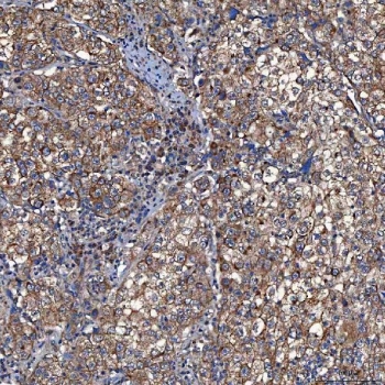 IHC staining of FFPE human cervical cancer tissue with TOMM34 antibody. HIER: boil tissue sections in pH8 EDTA for 20 min and allow to cool before testing.