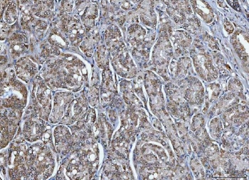IHC staining of FFPE human prostate cancer tissue with TRIM16 antibody. HIER: boil tissue sections in pH8 EDTA for 20 min and allow to cool before testing.