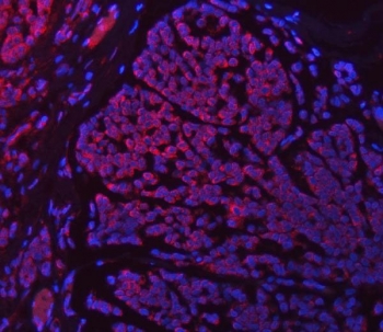 Immunofluorescent staining of FFPE human breast cancer tissue with SETD3 antibody (red) and DAPI nuclear stain (blue). HIER: steam section in pH8 EDTA buffer for 20 min.