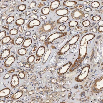 IHC staining of FFPE human renal cancer tissue with SEC31A antibody. HIER: boil tissue sections in pH8 EDTA for 20 min and allow to cool before testing.