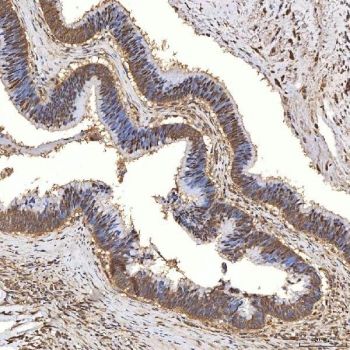 IHC staining of FFPE human colon adenocarcinoma tissue with SDCBP2 antibody. HIER: boil tissue sections in pH8 EDTA for 20 min and allow to cool before testing.