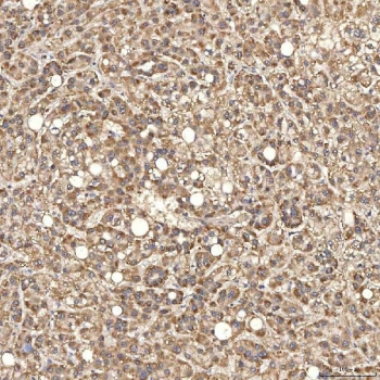 IHC staining of FFPE human liver cancer tissue with SDCBP2 antibody. HIER: boil tissue sections in pH8 EDTA for 20 min and allow to cool before testing.