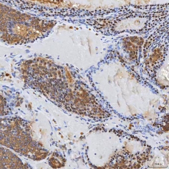 IHC staining of FFPE human breast cancer tissue with SDCBP2 antibody. HIER: boil tissue sections in pH8 EDTA for 20 min and allow to cool before testing.