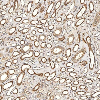 IHC staining of FFPE human renal cancer tissue with SDCBP2 antibody. HIER: boil tissue sections in pH8 EDTA for 20 min and allow to cool before testing.