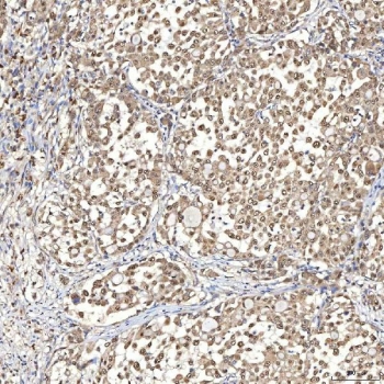 IHC staining of FFPE human lung adenocarcinoma tissue with SDCBP2 antibody. HIER: boil tissue sections in pH8 EDTA for 20 min and allow to cool before testing.