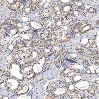 IHC staining of FFPE human prostate adenocarcinoma tissue with SDCBP2 antibody. HIER: boil tissue sections in pH8 EDTA for 20 min and allow to cool before testing.