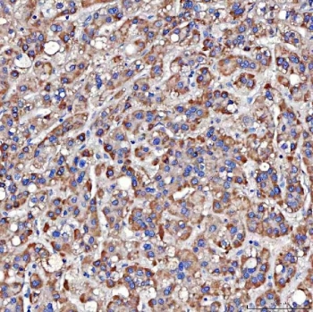 IHC staining of FFPE human liver cancer tissue with TTLL2 antibody. HIER: boil tissue sections in pH8 EDTA for 20 min and allow to cool before testing.