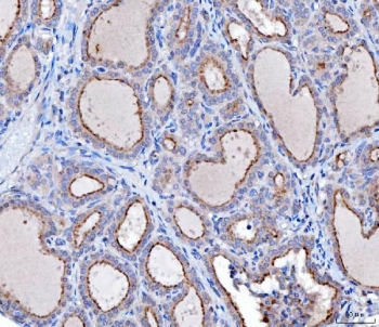 IHC staining of FFPE human thyroid cancer tissue with hDKIR antibody. HIER: boil tissue sections in pH8 EDTA for 20 min and allow to cool before testing.