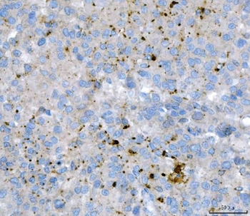 IHC staining of FFPE human liver cancer tissue with hDKIR antibody. HIER: boil tissue sections in pH8 EDTA for 20 min and allow to cool before testing.