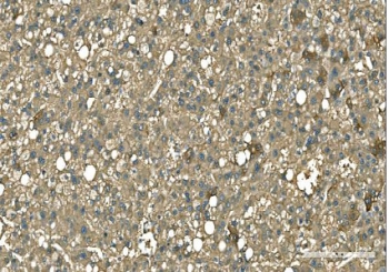 IHC staining of FFPE human liver cancer tissue with GOT1 antibody. HIER: boil tissue sections in pH8 EDTA for 20 min and allow to cool before testing.