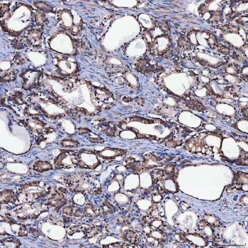 IHC staining of FFPE human prostate adenocarcinoma tissue with SH2D4A antibody. HIER: boil tissue sections in pH8 EDTA for 20 min and allow to cool before testing.