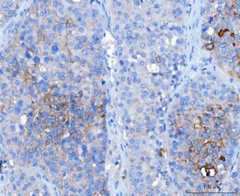 IHC staining of FFPE human hepatocellular carcinoma tissue with DSG2 antibody. HIER: boil tissue sections in pH8 EDTA for 20 min and allow to cool before testing.