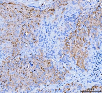 IHC staining of FFPE human laryngeal squamous cell carcinoma tissue with DSG2 antibody. HIER: boil tissue sections in pH8 EDTA for 20 min and allow to cool before testing.