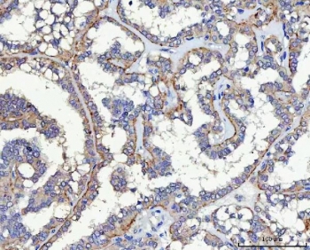 IHC staining of FFPE human thyroid cancer tissue with HP59 antibody. HIER: boil tissue sections in pH8 EDTA for 20 min and allow to cool before testing.