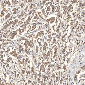 IHC staining of FFPE human breast cancer tissue with SLC22A8 antibody. HIER: boil tissue sections in pH8 EDTA for 20 min and allow to cool before testing.