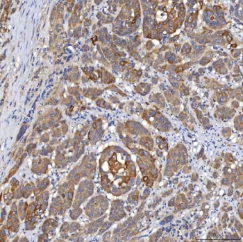 IHC staining of FFPE human prostate adenocarcinoma tissue with SLC22A8 antibody. HIER: boil tissue sections in pH8 EDTA for 20 min and allow to cool before testing.