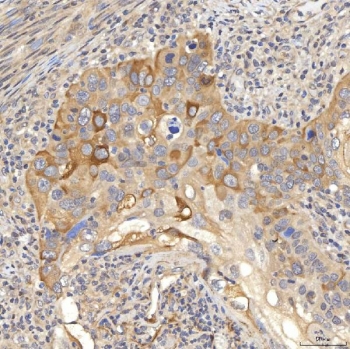 IHC staining of FFPE human larynx squamous cell carcinoma tissue with SLC22A8 antibody. HIER: boil tissue sections in pH8 EDTA for 20 min and allow to cool before testing.