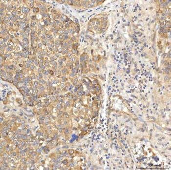 IHC staining of FFPE human liver cancer tissue with SLC22A8 antibody. HIER: boil tissue sections in pH8 EDTA for 20 min and allow to cool before testing.