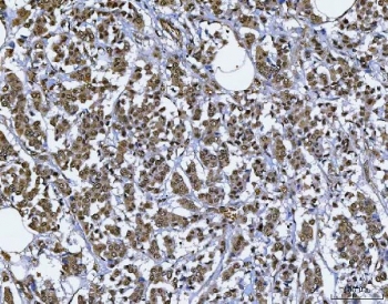 IHC staining of FFPE human breast cancer tissue with BAF57 antibody. HIER: boil tissue sections in pH8 EDTA for 20 min and allow to cool before testing.