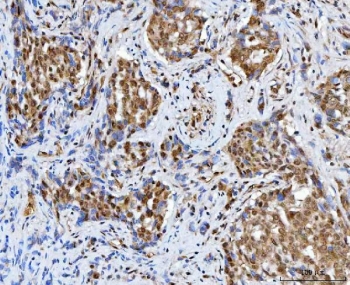 IHC staining of FFPE human lung cancer tissue with BAF57 antibody. HIER: boil tissue sections in pH8 EDTA for 20 min and allow to cool before testing.