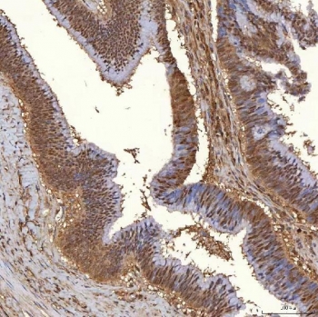 IHC staining of FFPE human colon adenocarcinoma tissue with PIG3 antibody. HIER: boil tissue sections in pH8 EDTA for 20 min and allow to cool before testing.