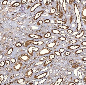 IHC staining of FFPE human renal cancer tissue with PIG3 antibody. HIER: boil tissue sections in pH8 EDTA for 20 min and allow to cool before testing.