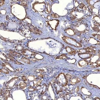 IHC staining of FFPE human prostate adenocarcinoma tissue with PIG3 antibody. HIER: boil tissue sections in pH8 EDTA for 20 min and allow to cool before testing.