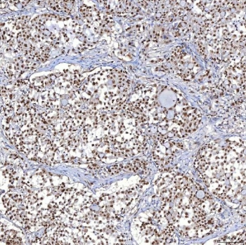 IHC staining of FFPE human lung adenocarcinoma tissue with TRMT61A antibody. HIER: boil tissue sections in pH8 EDTA for 20 min and allow to cool before testing.