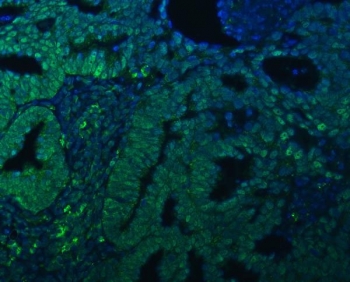 Immunofluorescent staining of FFPE human ovarian cancer tissue with TRMT61A antibody (green) and DAPI nuclear stain (blue). HIER: steam section in pH8 EDTA buffer for 20 min.