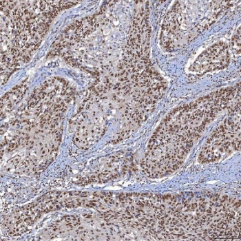 IHC staining of FFPE human larynx squamous cell carcinoma tissue with TRMT61A antibody. HIER: boil tissue sections in pH8 EDTA for 20 min and allow to cool before testing.