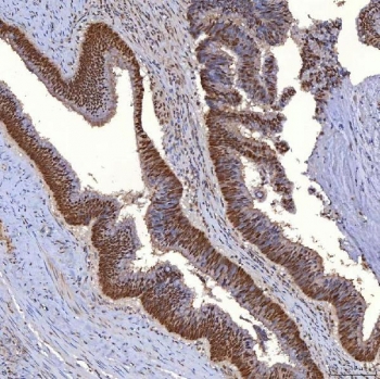 IHC staining of FFPE human colon adenocarcinoma tissue with TRMT61A antibody. HIER: boil tissue sections in pH8 EDTA for 20 min and allow to cool before testing.