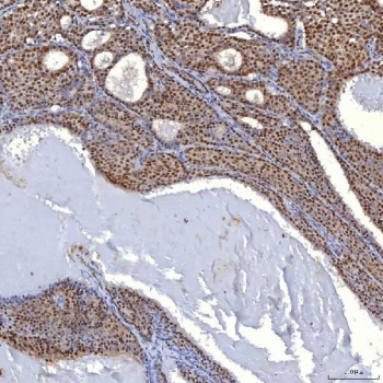 IHC staining of FFPE human breast cancer tissue with TRMT61A antibody. HIER: boil tissue sections in pH8 EDTA for 20 min and allow to cool before testing.
