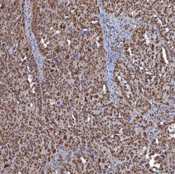 IHC staining of FFPE human ovarian serous cancer tissue with TRMT61A antibody. HIER: boil tissue sections in pH8 EDTA for 20 min and allow to cool before testing.