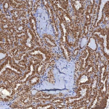 IHC staining of FFPE human thyroid cancer tissue with TRMT61A antibody. HIER: boil tissue sections in pH8 EDTA for 20 min and allow to cool before testing.