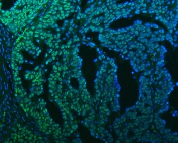 Immunofluorescent staining of FFPE human ovarian cancer tissue with SAP130 antibody (green) and DAPI nuclear stain (blue). HIER: steam section in pH8 EDTA buffer for 20 min.