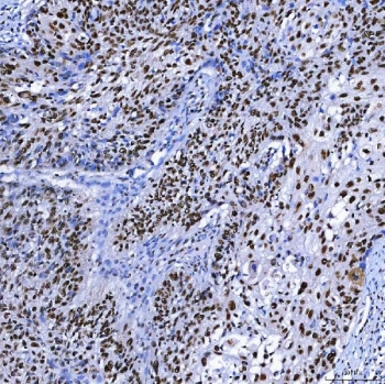 IHC staining of FFPE human larynx squamous cell carcinoma tissue with SAP130 antibody. HIER: boil tissue sections in pH8 EDTA for 20 min and allow to cool before testing.