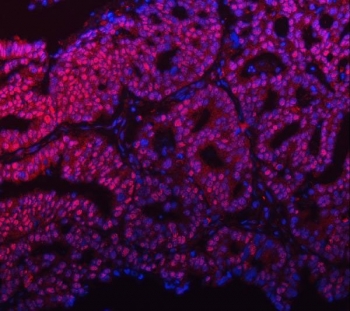 Immunofluorescent staining of FFPE human ovarian cancer tissue with mSin3A antibody (red) and DAPI (blue). HIER: steam section in pH8 EDTA buffer for 20 min.