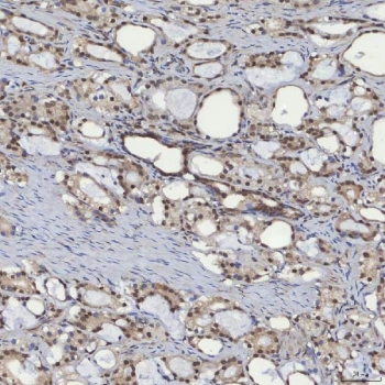 IHC staining of FFPE human prostate adenocarcinoma tissue with mSin3A antibody. HIER: boil tissue sections in pH8 EDTA for 20 min and allow to cool before testing.
