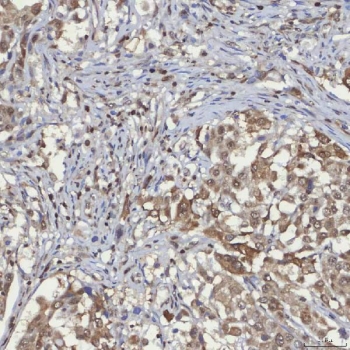 IHC staining of FFPE human lung adenocarcinoma tissue with mSin3A antibody. HIER: boil tissue sections in pH8 EDTA for 20 min and allow to cool before testing.