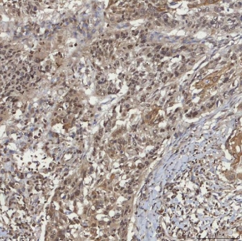 IHC staining of FFPE human larynx squamous cell carcinoma tissue with mSin3A antibody. HIER: boil tissue sections in pH8 EDTA for 20 min and allow to cool before testing.